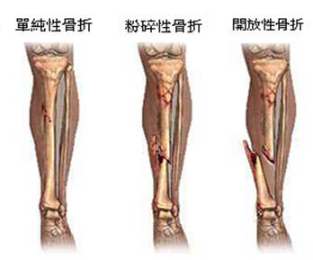 大腿 骨 頸 部 骨折 治療